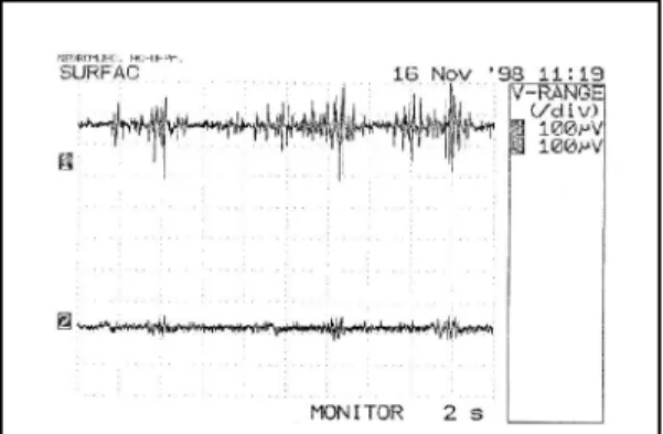 Fig 2. Electromyography (sumatriptan in the Case 1).