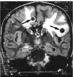 Fig 1. Axial head CT at the basal ganglia level on day one of admission shows a hyperdense rounded lesion (large white arrow), with its center being somewhat less dense, in left frontal subcortical area, and severe bifrontal white matter swelling (small bl