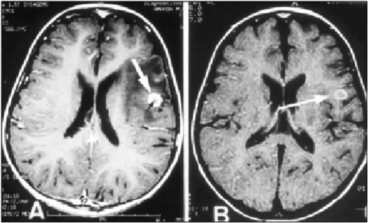 Fig 3. A, Axial T1-weighted (TR = 466 ms, TE = 14 ms) MRI after gadolinium administration