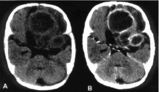 Fig 1. Initial unhanced CT scan (A) and after iodine contrast enhancement (B). Rounded expansive formations with a central low-density component and a ring-like contrast-enhancing periphery, shown in the frontal and temporal regions of the left hemisphere