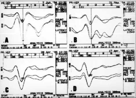 Fig 2. Case 10. Slight reduction of the N 19  and P 22  latencies in the progesterone phase (B) in relation to the estrogen phase (A)