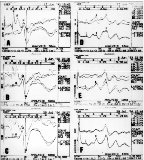 Fig 3. Case 16. Slight reduction of the N 19  and P 22  latencies in the progesterone phase (B) in relation to the estrogen phase (A)