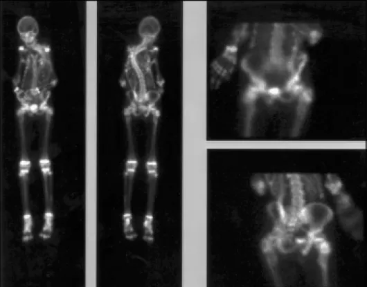 Fig 2. Whole body and spot images of the bone scan, with mild abnormal tracer uptake in the soft tissues of the left lumbar paravertebral region, posterior chest wall, right arm and right hip (soft tissue calcification).