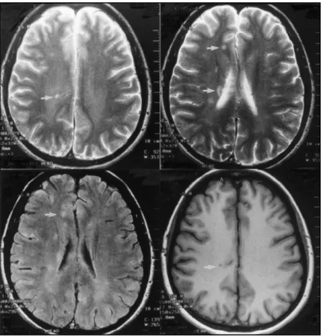 Fig 2. MRI from Patient 2: A) and B) T2-weighted, C) FLAIR and D) T1-IR images showing small subcortical periventricular lesions, hyperintense in T2 and FLAIR and hypointense in T1