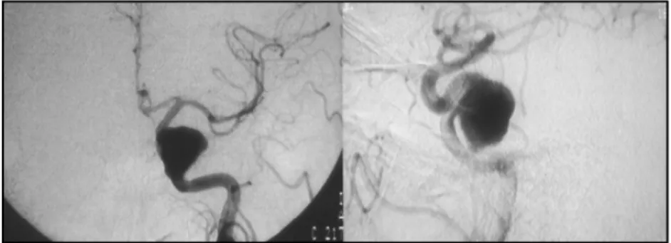 Fig 4. Case 2- DSA showing a giant aneurysm of the left cavernous ICA.
