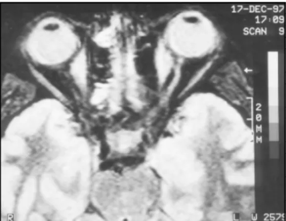 Fig 2. Normal MRI (second episode).