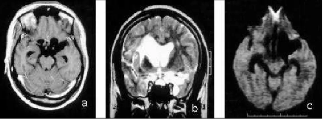 Fig 1. Cysterns racemose form:  a) Axial contrast enhanced T1 Wl;  b) Coronal T2 Wl;  c) Axial diffusion Wl.