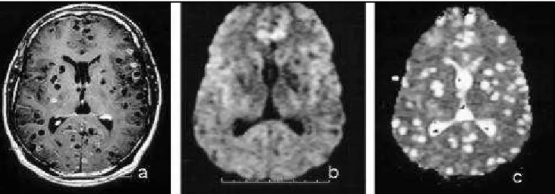 Table 1. Calculat ed ADC values according t o t he t ype of t issue st udied in 16 pat ient s w it h neurocyst icercosis.