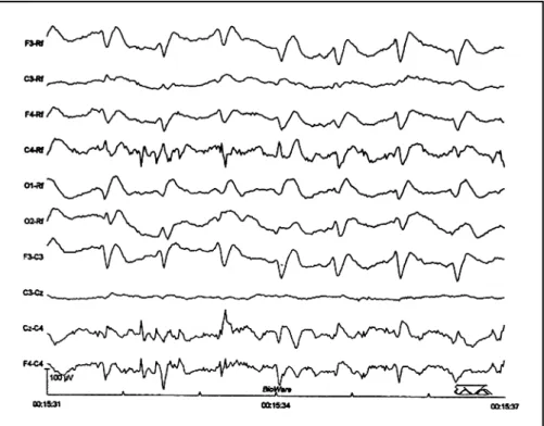Fig 2. Immunoassay for 14-3-3 prot ein in CSF. CSF from pat ient w it h V210I mut at ion (P) show s a  band corresponding  t o 14-3-3 β  isoform