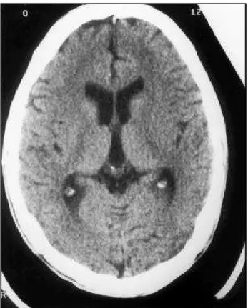 Fig 1. Head CT scan pre thrombolysis w ithout intra-cranial hem- hem-orrhage.