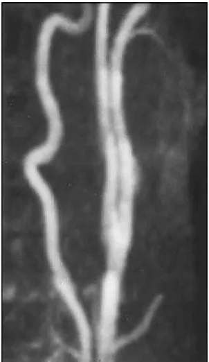 Fig 3. M RA of  ext ra-cranial lef t  int ernal carot id art ery reveals normal lumen 1 year later.