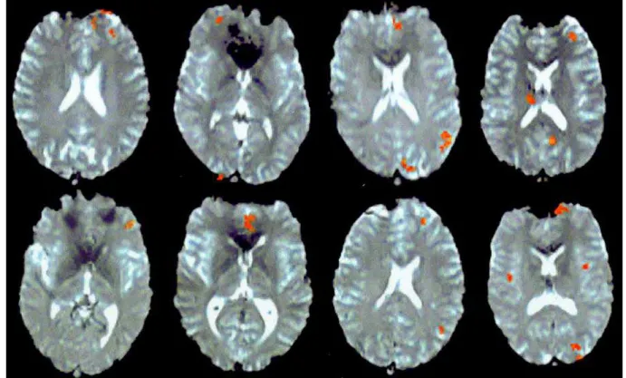Fig 1. Activation results of moral versus factual judgment using simple linear regressions (r > 0.23, p < 0.01, extent threshold = 6 voxels) from eight subjects overlaid on their source transversal echoplanar images at the level of the frontal poles