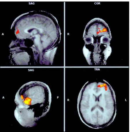 Fig  2.  Group  activations  coregistered  with  the averaged anatomical brain of all subjects (p <