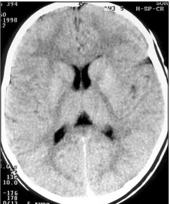 Fig 1. Basal ganglia calcification.