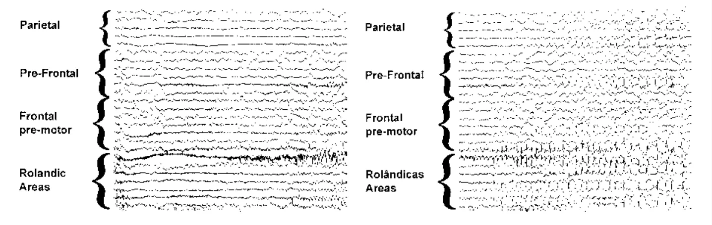 Fig 1. Left: ECoG sample obtained from Patient II showing focal ictal onset over the lower banks of the rolandic cortex