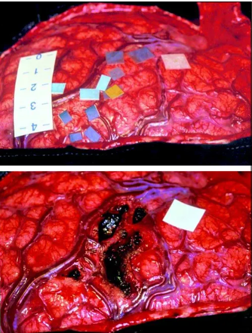 Fig 2. Above: Patient IIs intraopera- intraopera-tive view of the exposed brain  conve-xity with superimposed  neurophysi-ological data