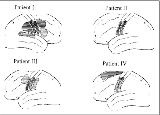 Fig 4. Summary of the topography of the resections performed in this series.