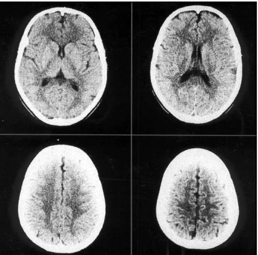 Fig  2.  Follow-up  brain  CT  of  Patient  2,  five  months  later,  shows  complete  resolution  of  the previous lesions.