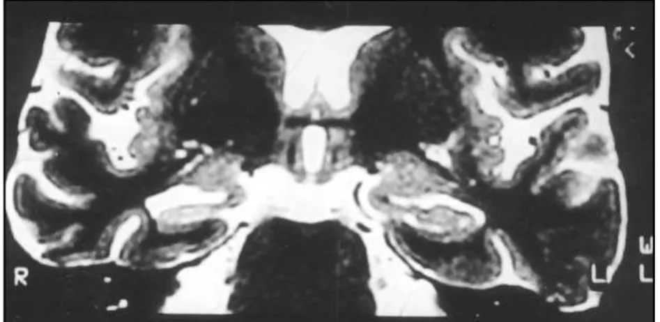 Fig 1. Pre-surgery MRI from the patient: coronal T2.