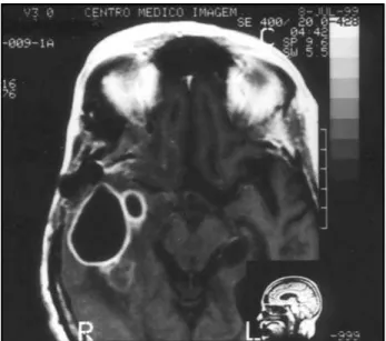Fig 2. Gadolinium-enhanced T 1 -weighted axial image depicting a right temporal abscess four months after the first surgical procedure.