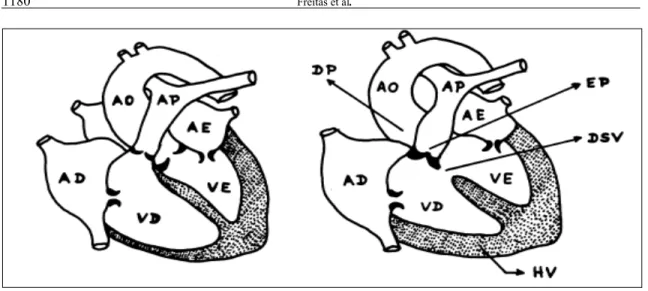 Figura 1 - Esquema comparativo entre um coração normal e outro com Tetralogia de Fallot, demonstrando os quatros principais defeitos desta  moléstia  cardíaca  congênita