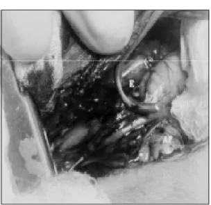 Figura  3  -  Artéria  subclávia  esquerda  pinçada  previamente  à execução  da  anastomose  termino-lateral  na  artéria pulmonar