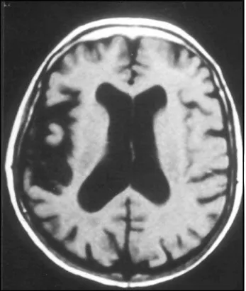 Fig 5 (patient 3). Left parietal atrophy.
