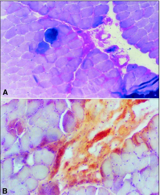 Fig 2. Muscle Biopsy. A. Amyloid material involving the vessel walls. (Magnification x174, Crystal Violet)