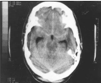 Fig 1. CT scan obtained after the patient admission revealing a diffuse subarachnoid hemorrhage.
