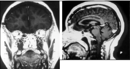 Fig 3. Post-operative magnetig reso- reso-nance images. T1-weighted coronal (A) and sagittal (B) images obtained after IV administration of gadolinium demonstrated the absence of any  re-sidual or recurrent tumor