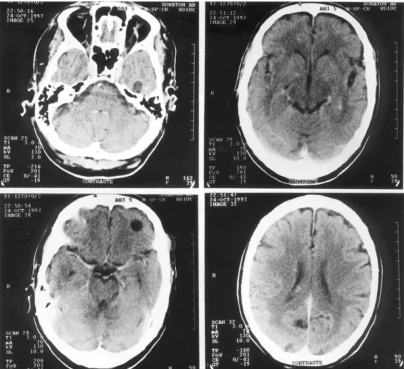 Fig 1. CT scan showing multiple cortical cysts, with contrast  enhance-ment (more evident in the left temporal lobe cyst).