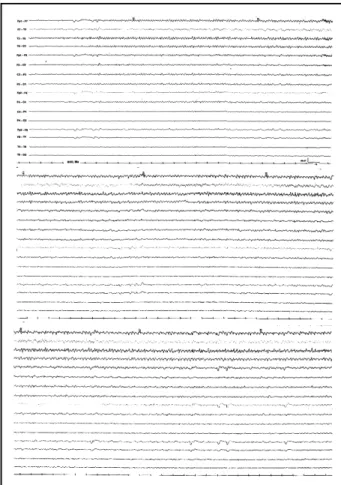 Fig 2. EEG performed during the acute infection, showing a left temporal onset seizure, clinically compatible with complex  par-tial seizure.