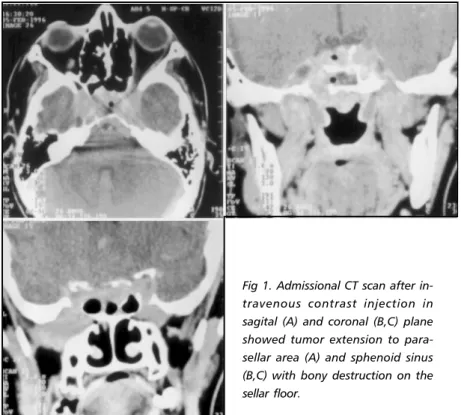 Fig 1. Admissional CT scan after in- in-travenous contrast injection in sagital (A) and coronal (B,C) plane showed tumor extension to  para-sellar area (A) and sphenoid sinus (B,C) with bony destruction on the sellar floor.