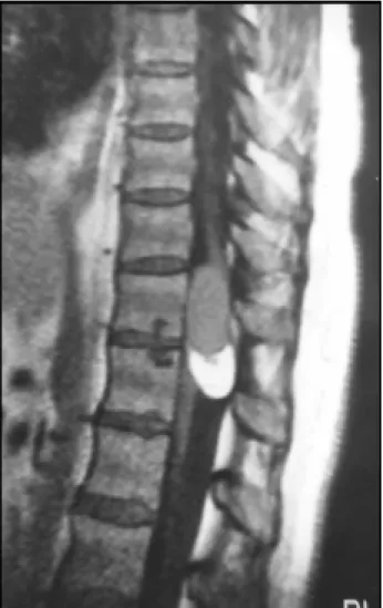 Fig 2. Axial section in T2-weighted dor- dor-sal resonance images (TR 5600 / TE 140) showing the cyst with high-signal  inten-sity occuping the whole spinal canal at D11 level (upper images) and the lipoma expelling the spinal cord in the  antero-lateral p