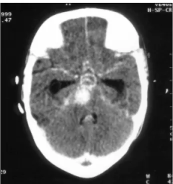 Fig 1. CT scan showng a giant saccular aneurysm possibly emerg- emerg-ing from the left basilar artery.