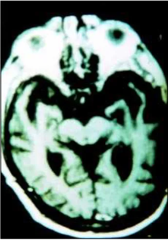 Fig 1. MR transaxial image showing marked bilateral temporal atrophy, mainly on left hippocampus and parahippocampus gyri.
