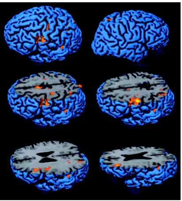 Fig 1. Three-dimensional surf ace renderings of  group act ivat ion result s f rom all subject s overlaid on a represent at ive Talairach-t ransf ormed brain