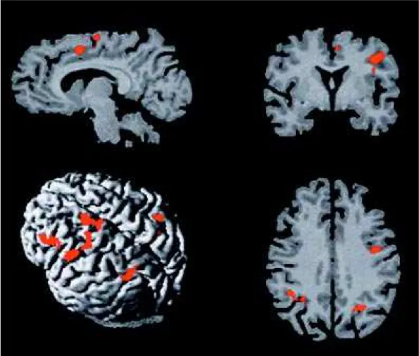 Fig 2. A:  M edial w all of  t he lef t  f ront al lobe show ing act ivat ion in t he cingulat e sulcus (CS) and supplement ary mot or area (SM A)