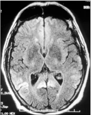Fig 2. Axial DWI (TR/TE 9999/92.6), approximat ely at  t he same level as t he previous image, depict s unequivocal hyperint ense signal in t he front al, t emporal and occipit al cort ices bilat erally.