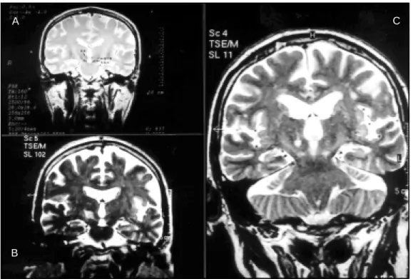 Fig 1. T2-w eight ed 3D coronal M RI. A- Landmarks f or ident if icat ion of  STN (subt halamic nucleus):  14 t o 18 mm post erior t o AC (ant erior commissure);  superior and medial t o t he apex of  t he choroidal f issure;   supe-rior and lat eral t o S