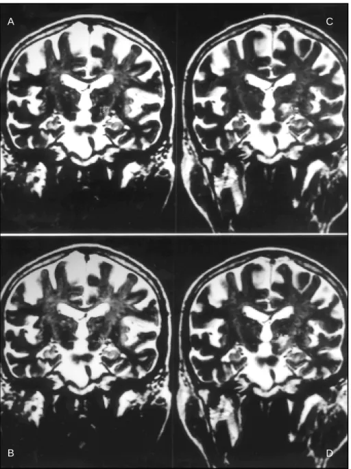 Fig 2. Pre- and post operat ive M RI show ing, respect ively, t he vert ical (A) and horizont al (B) diamet ers of  STN, and t he vert ical (C) and horizont al (D) diamet ers of  t he lesion.