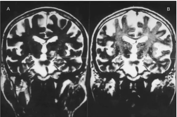 Fig 3. Pre- (upper row ) and post operat ive (low er row ) T2-w eight ed 3D coronal M RI f rom a single pat ient show ing exact ly t he same ant eropost erior dist ance (15 mm) bet w een  STN [1 mm post  (arrow  in B)] or lesion [6 mm post  (D)] and AC [14