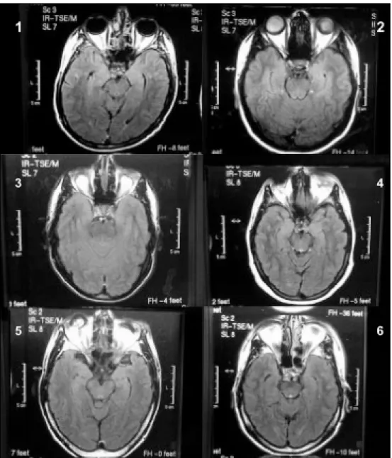 Fig 1.  M RI of  t he pat ient s(T2-FLAIR):  Normal visual pat hw ays (Pat ient  1);  absence of  t he cryst alline (Pat ient  2);  lacked t he eyeballs (Pat ient s 3,4,and 6);  signal abnormalit ies in bot h eyeballs (Pat ient  5).