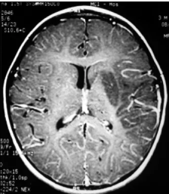 Fig 1. CT. Pacient  1 - Lef t  midle cerebral art ery t errit ory involved. Fig 2. CT