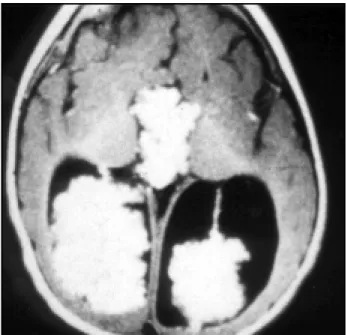 Fig 1. CT (w it hout  cont rast ) performed at  one mont h of age, show ing ventricular dilation.