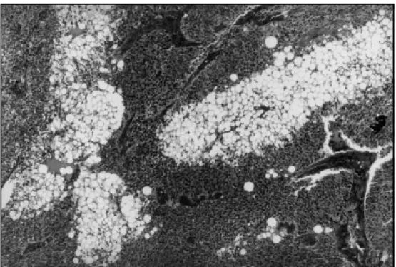 Fig 1. Histological architecture of the neoplasm focusing islands of lipomatous tissue intermingled with a small blue cell  component (HE; x 100).