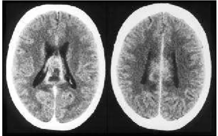 Fig 1. CT scan: lesion in the splenium of the corpus calosum with heterogenous enhancing pattern.
