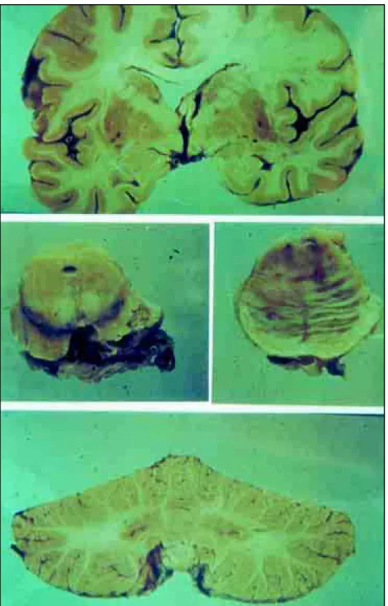 Fig 1. Macroscopically normal brain, mesencephalon, pons and cerebellum.
