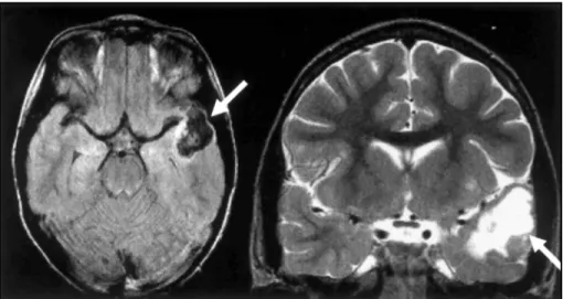 Fig 1. Patient 1. MRI. The figures show a cystic lesion with solid mural nodule on left temporal lobe.