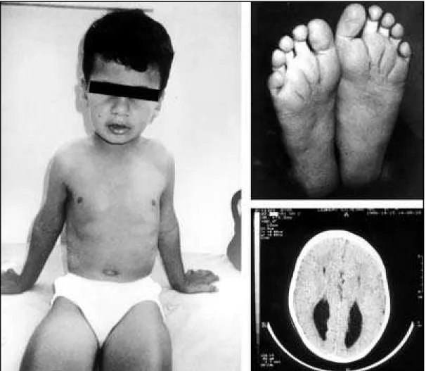 Fig 1. Mosaic trisomy 8. Note eversion of lower lip, deep furrows on soles, and CT scan showing absence of corpus callosum.
